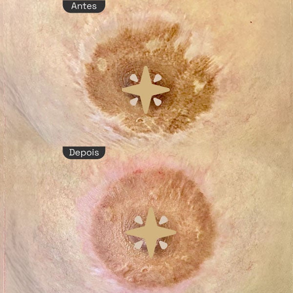 Reconstrução de Aréolas - Antes e Depois