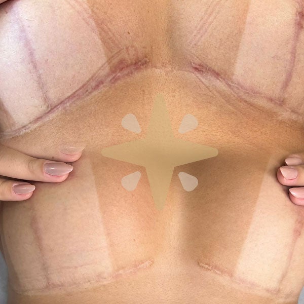 Camuflagem de Cicatrizes - Antes e Depois