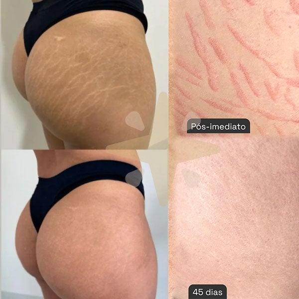 Camuflagem de Estrias - Antes e Depois