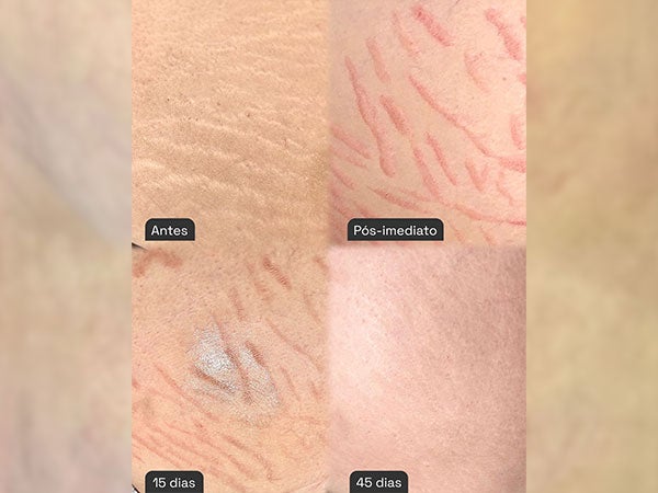 Camuflagem de Estrias - Antes e Depois